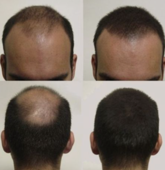 Foto do couro cabeludo de um homem mostrando o antes e depois do uso de finasterida e minoxidil