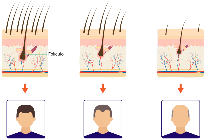 Áreas do couro cabeludo afetadas pela alopecia androgenética.