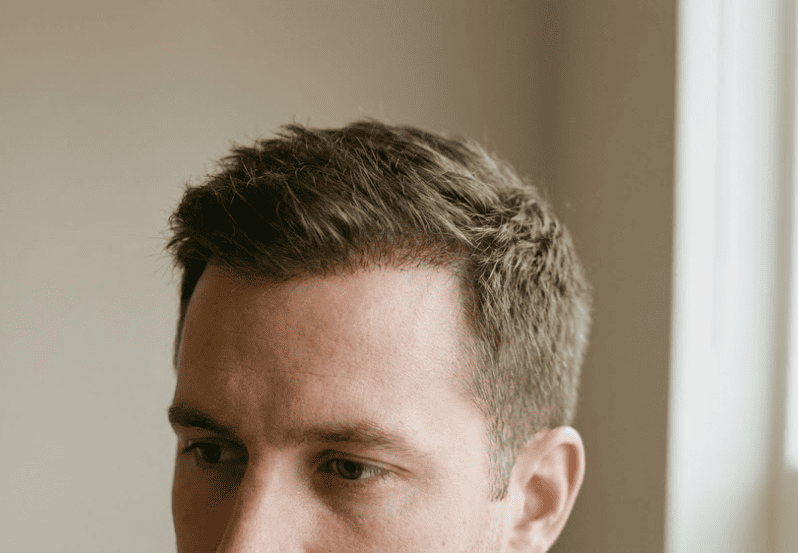 Resultado natural de implante capilar com linha frontal bem definida 